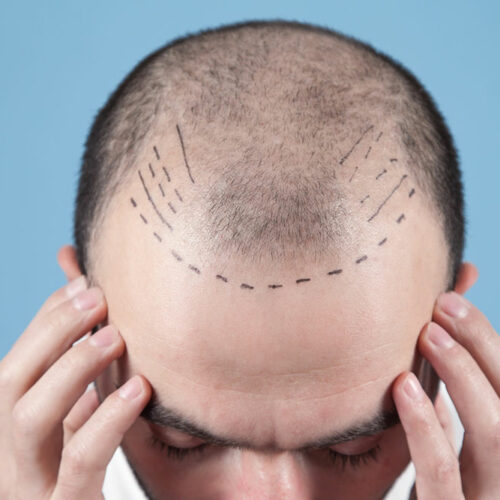 Hair Transplant – Techniques, Costs, and More