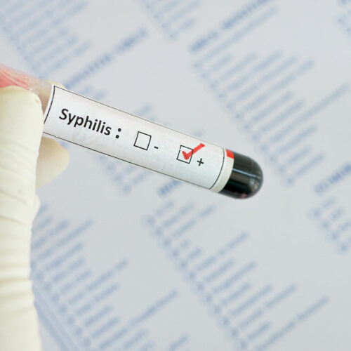 Syphilis &#8211; Early Signs and Diagnosis