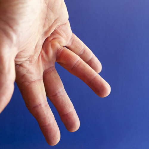 Dupuytren’s Contracture &#8211; Causes, Symptoms, and Home Remedies