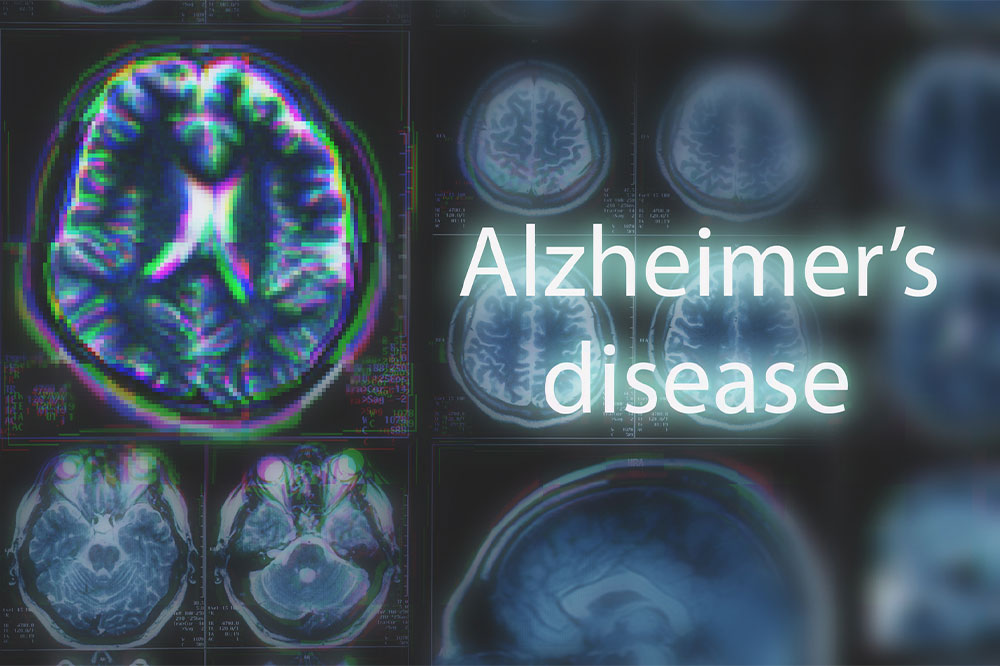 10 Early Signs of Alzheimer&#8217;s Disease