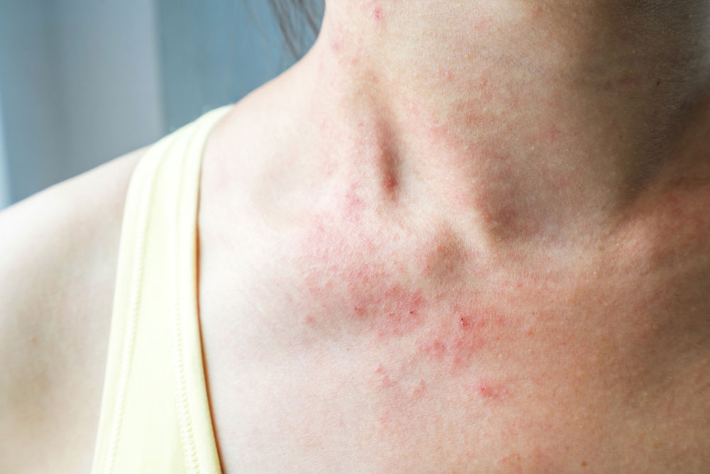 Mycosis fungoides &#8211; more than just a skin rash