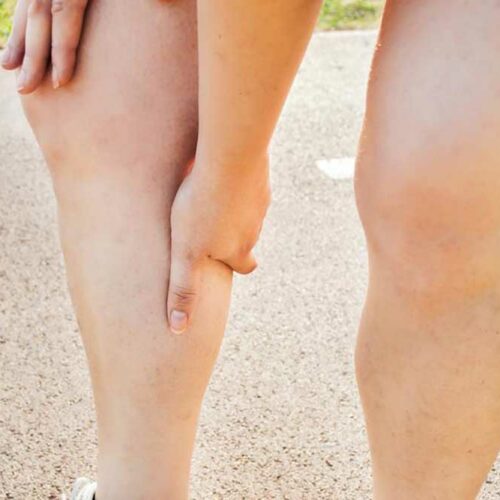 Common Symptoms of Deep Vein Thrombosis