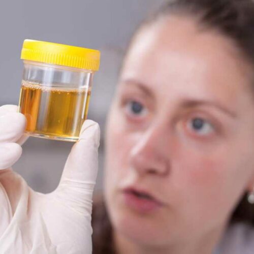 Determining Your Health with a Urine Color Chart