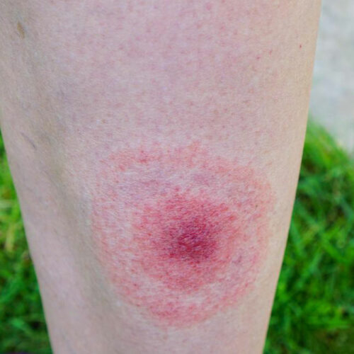 Early signs of lyme disease