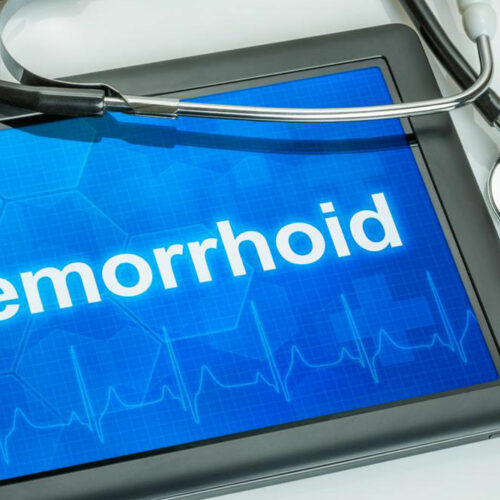 Hemorrhoids: What they are and their causes