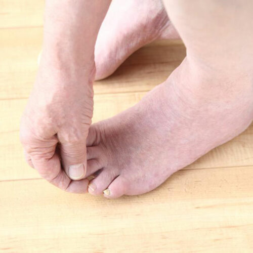 Important things to know about toenail fungus