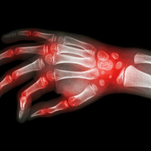 Rheumatoid arthritis and lupus – what makes them similar?