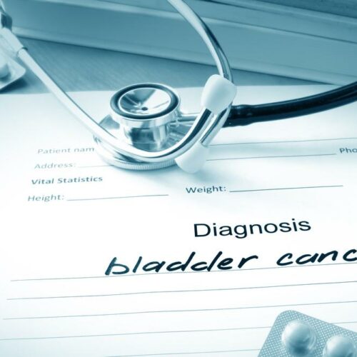 The Common Causes of Bladder Cancer