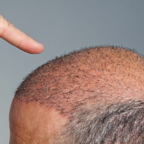 The truth about how much hair transplants cost