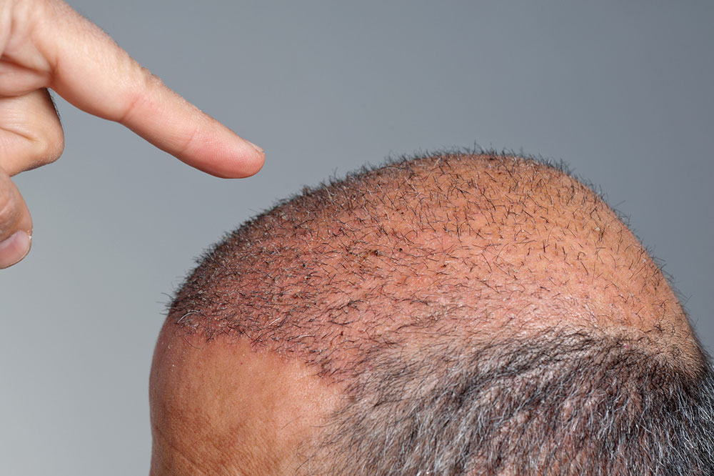 The truth about how much hair transplants cost