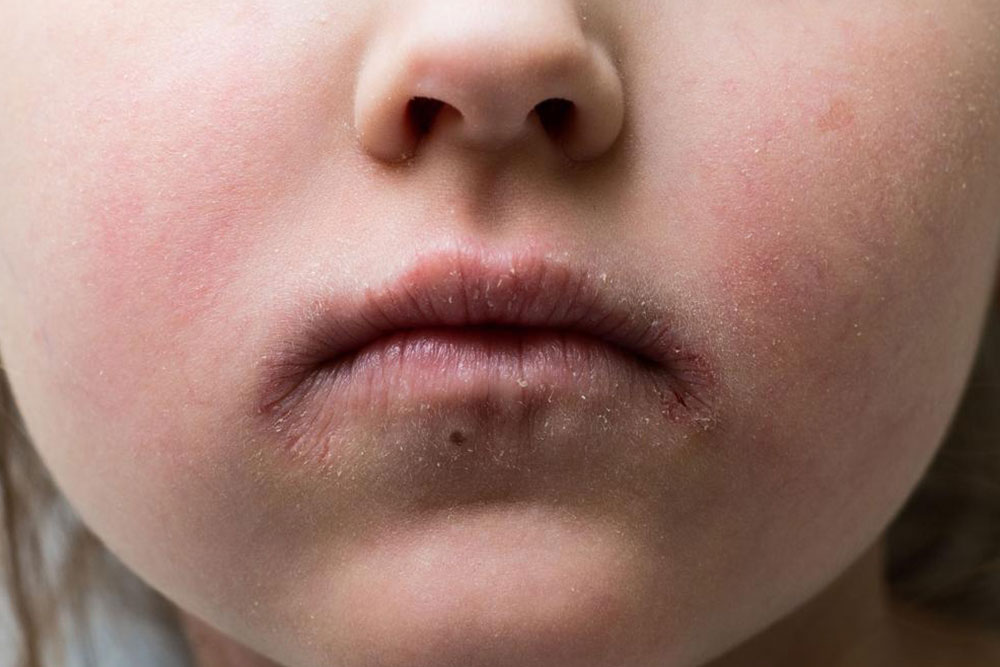 Understanding the causes of impetigo in children and adults