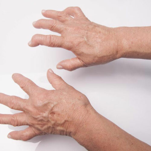 What you need to know about Rheumatoid Arthritis and Lupus