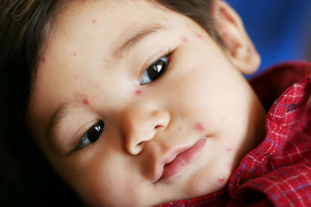 5 tell-tale signs of chickenpox you should know about