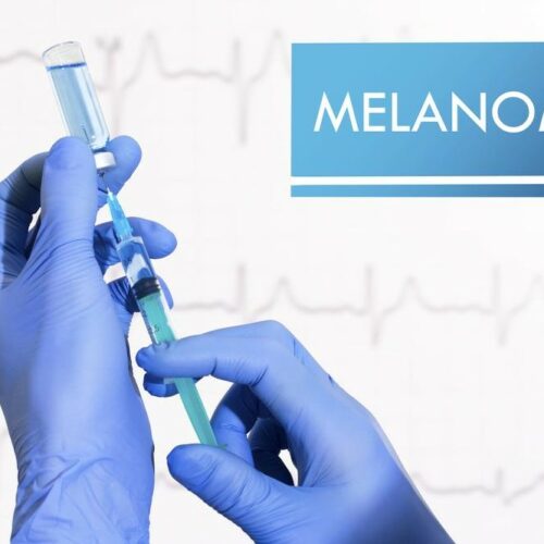 6 Common Risk Factors for Melanoma