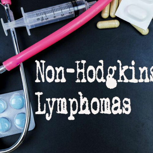 6 common risk factors for Non-Hodgkin lymphoma