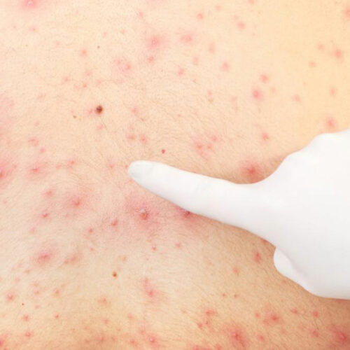 All You Need to Know About Pityriasis Rosea Treatments