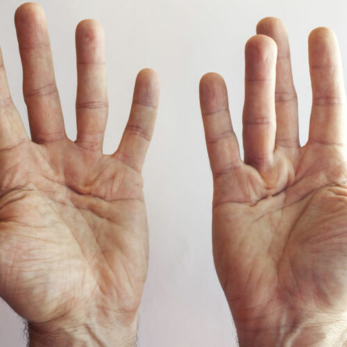 Dupuytren’s Contracture &#8211; Its Symptoms and Causes