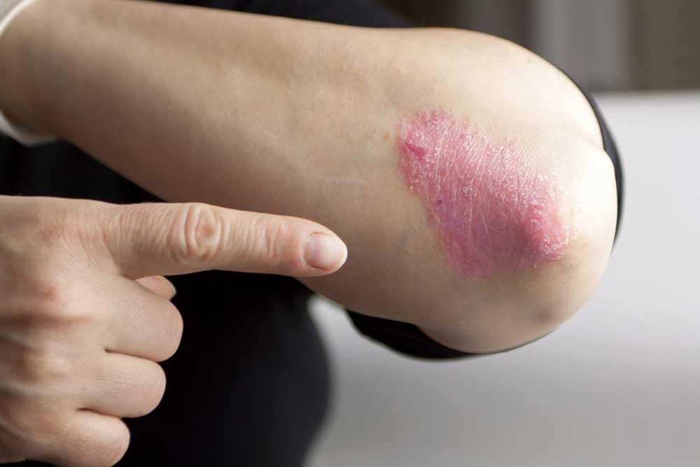 Home Remedies to Manage the Symptoms of Plaque Psoriasis