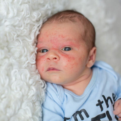 How Baby Eczema Differs With Age and Steroid Treatment