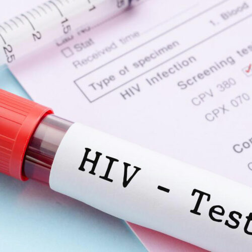 Know More About The Testing Of HIV