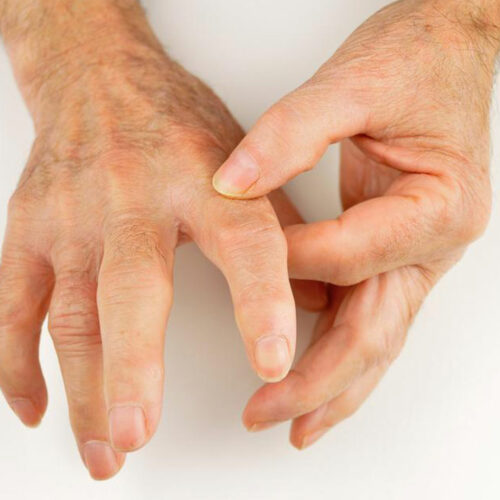 Popular Treatment Options for Rheumatoid Arthritis and Gout