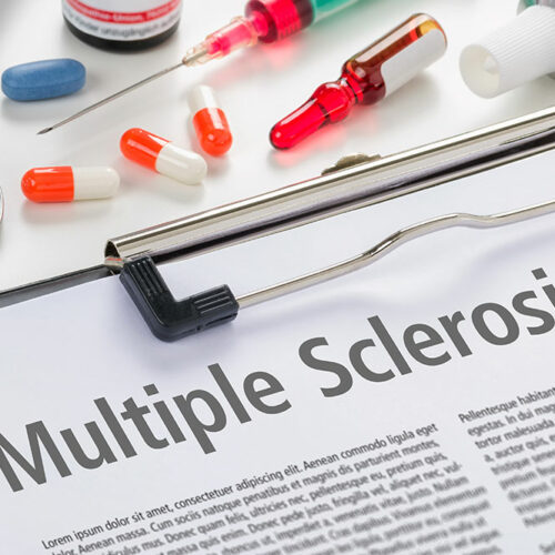 Stages, diagnosis, and prevention of multiple sclerosis