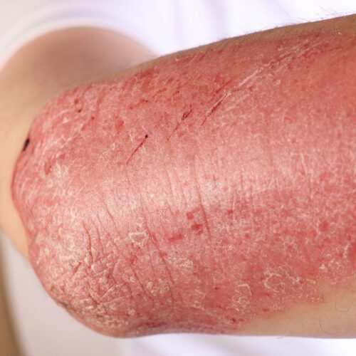 Symptoms, Causes, Types And Treament Of Eczema