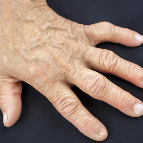 Signs of Rheumatoid Arthritis You Should Look out For