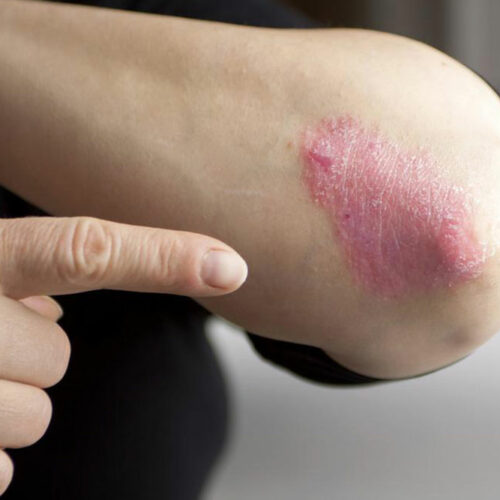 Types and Treatment of Chronic Psoriasis