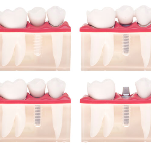 The various types of crowns and caps