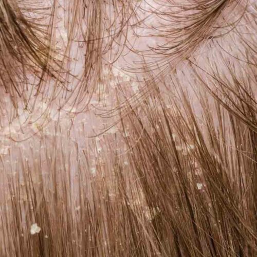 Useful Mild Treatment Solutions for Scalp Psoriasis Problem