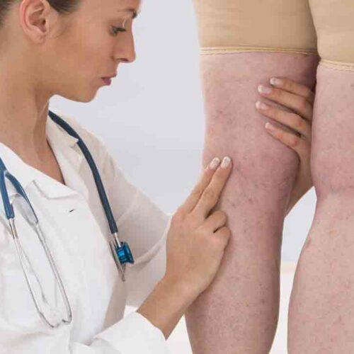 Various Symptoms of Deep Vein Thrombosis Worth Knowing