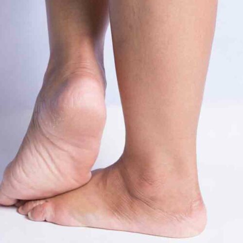 Walk In Stride By Treating Heel Pain