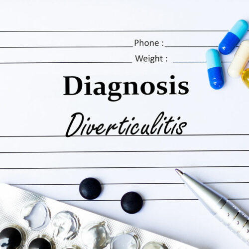 11 Foods that Trigger Diverticulitis