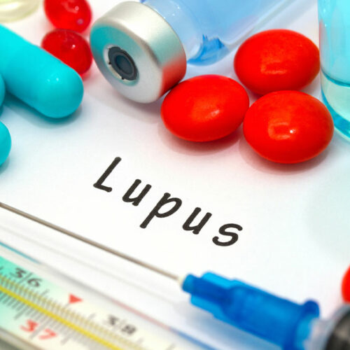 5 things to avoid with lupus