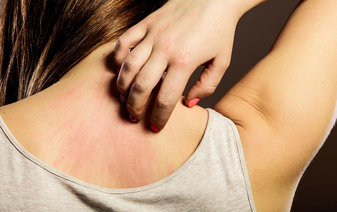 8 Simple Tips to Treat an Eczema Rash