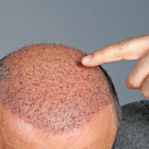 Hair Transplant Cost and Procedure